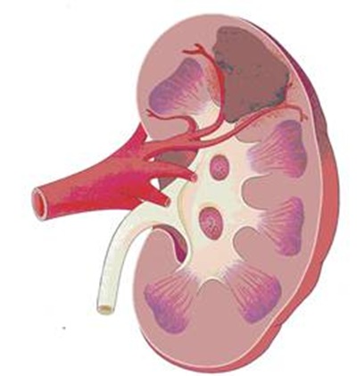 Nuevos avances en tratamiento del cáncer renal