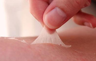 Tratamiento natural para las quemaduras solares