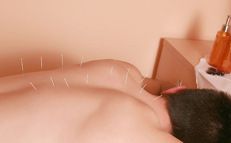 Acupuntura: Uso pre y post-cirugÃa Acupuntura: Uso pre y post-cirugÃa