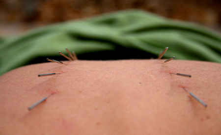 Acupuntura para mujeres embarazadas