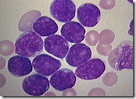 Leucemia infantil | Descubren genes que la causan