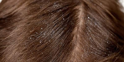 De los espinos cervales de mar el aceite a la psoriasis