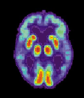 Un paso más en el tratamiento del Alzheimer Un paso más en el tratamiento del Alzheimer