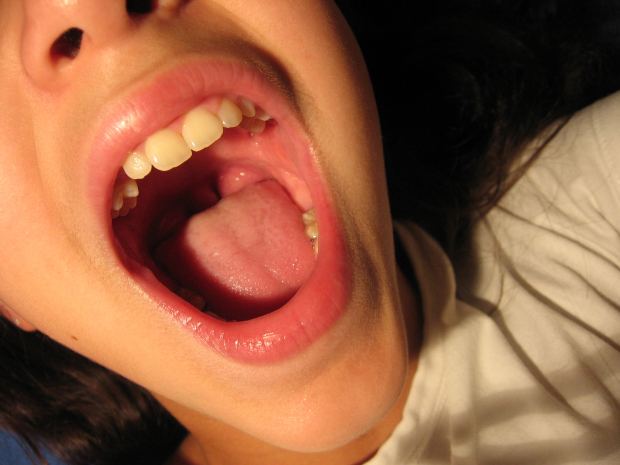 Halitosis: un consejo simple para prevenirla