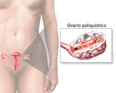 Ovarios poliquÃsticos Ovarios poliquÃsticos