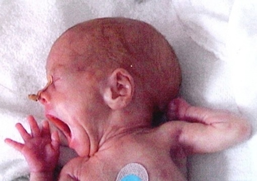 Síntomas de meningitis