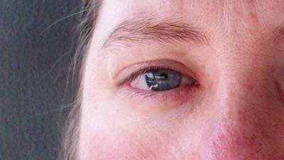 Recuerda que los ojos también pueden sufrir quemaduras solares Recuerda que los ojos también pueden sufrir quemaduras solares