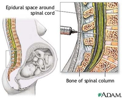 la anestesia epidural