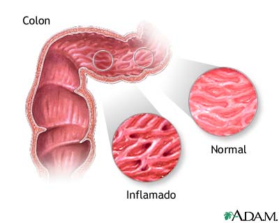 Enfermedad intestinal inflamatoria