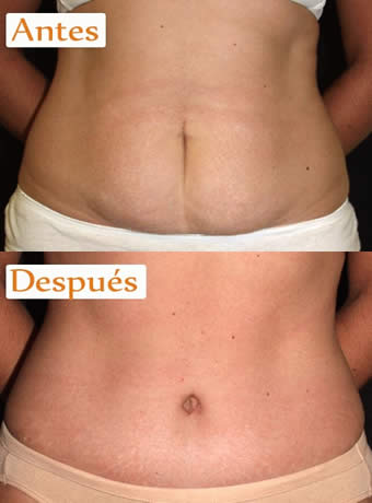 Para verse con un cuerpo espectacular recurra a la Lipocavitación un tratamiento sin cirugía Para verse con un cuerpo espectacular recurra a la Lipocavitación un tratamiento sin cirugía