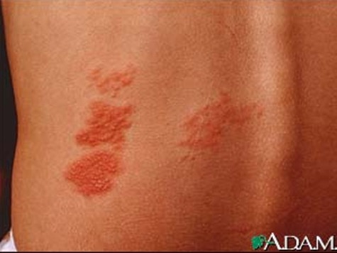 herpes-zoster-shingles-on-the-back