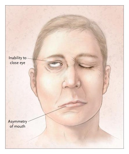 bells-palsy