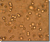 Embarazo e Infecciones Urinarias