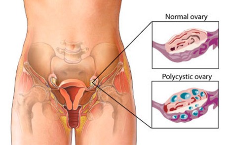 Causas de  infertilidad en la mujer