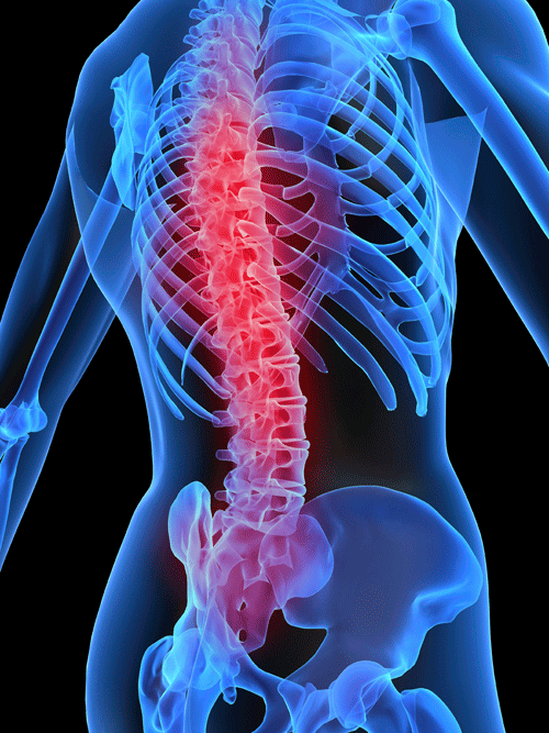 Osteoporosis, el mal de los huesos frágiles que casi nadie cree padecer