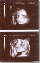 Ultrasonidos en el Embarazo