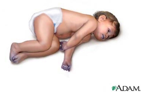salud del bebe la cioanosis