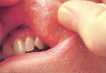 canker sores