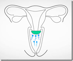 Diafragma: su uso como anticonceptivo