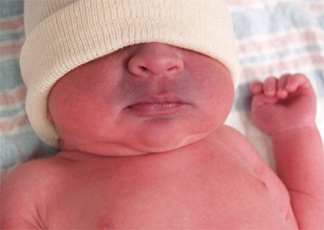 salud del bebe la cioanosis