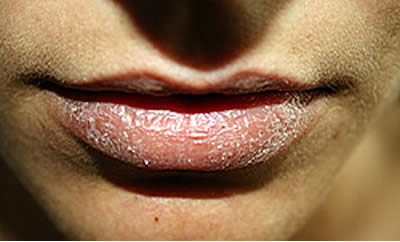 Tratamiento para quitar la sequedad de los labios