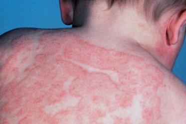 Lo que no debes hacer si sufres de dermatitis