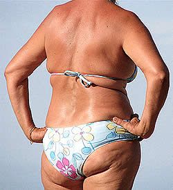 La celulitis y cómo combatirla La celulitis y cómo combatirla