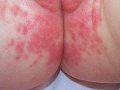 Dermatitis pañal | remedios caseros