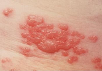 Todo sobre la intolerancia a la lactosa