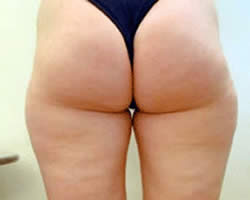 Celulitis en las nalgas