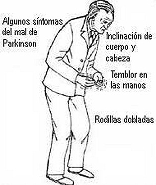 sintomas-del-parkinson