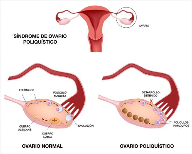 que es el sindrome de ovarios poliquisticos