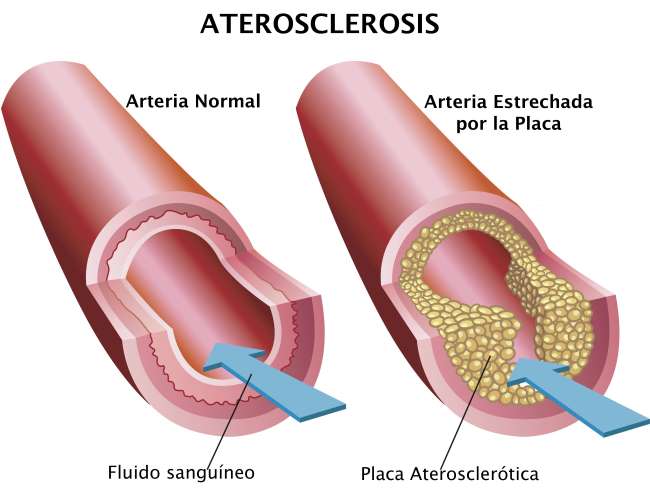 Dieta para la arterioesclerosis