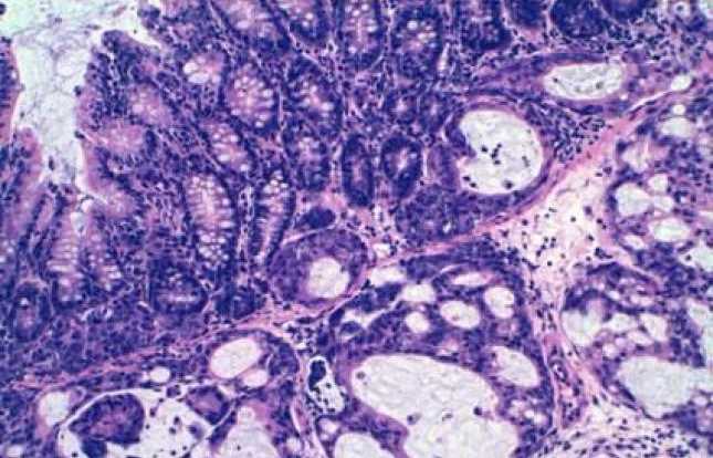 Las celulas tumorales de colon