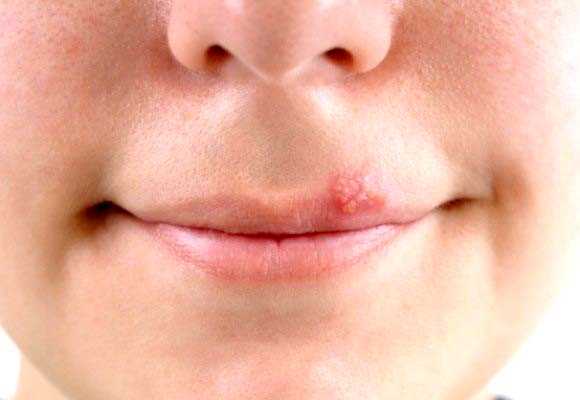 Como curar el herpes labial