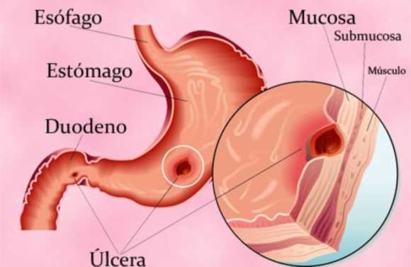 Remedios naturales para la ulcera de estomago