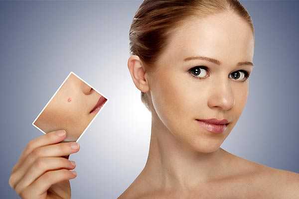Cicatrices del acne tratamiento natural