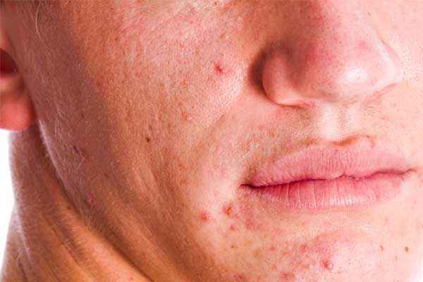 Lavado-facial-para-el-acne-y-rosacea-segun-nuestra-piel
