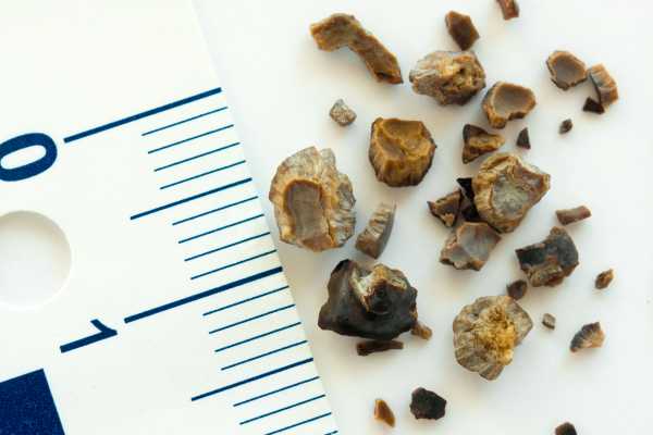 Piedras en el riñón como prevenir su aparición