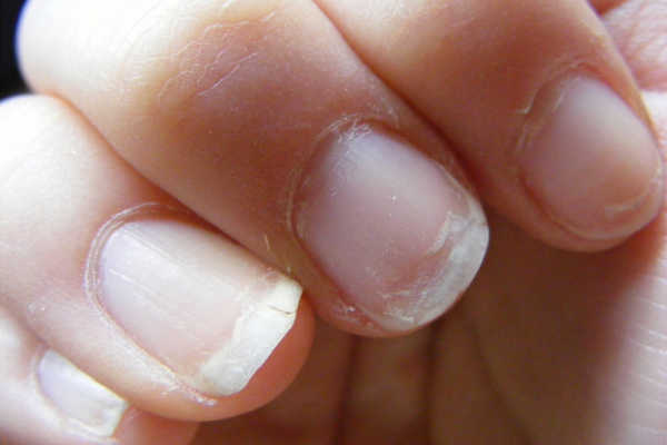 Cuidado de las uñas quebradizas de manera natural