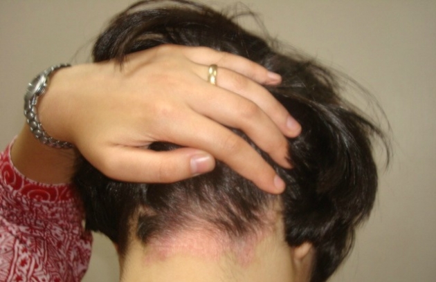 Cómo tratar la psoriasis del cuero cabelludo 3.jpg
