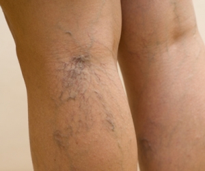 Consejos para prevenir varices 1.jpg