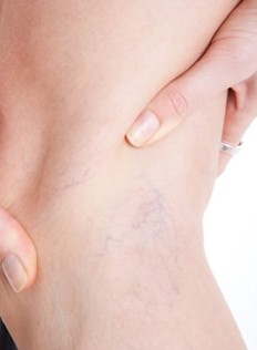 Consejos para prevenir varices 4.jpg