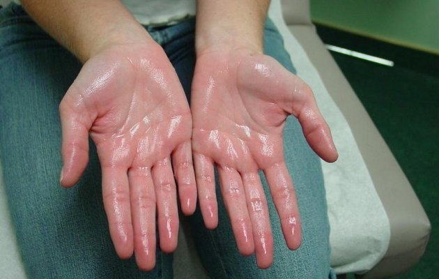 Sudor en las manos.JPG