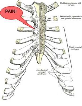 Tietzes-Syndrome-costal-cartilages