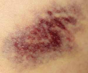 cómo evitar los moretones 2.jpg cómo evitar los moretones 2.jpg