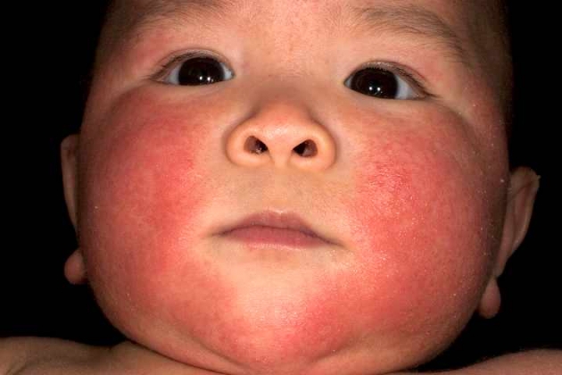 dermatitis_remedios_naturales_para_su_cura2.jpg