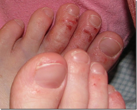 La psoriasis es el sida