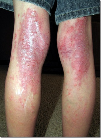 La psoriasis los síntomas y los métodos del tratamiento
