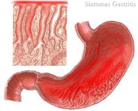 gastritis